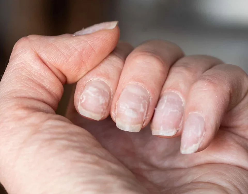 علت پوسته شدن ناخن